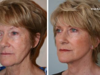 How Long Does a Facelift Last UK?
