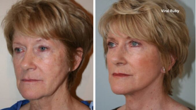 How Long Does a Facelift Last UK?